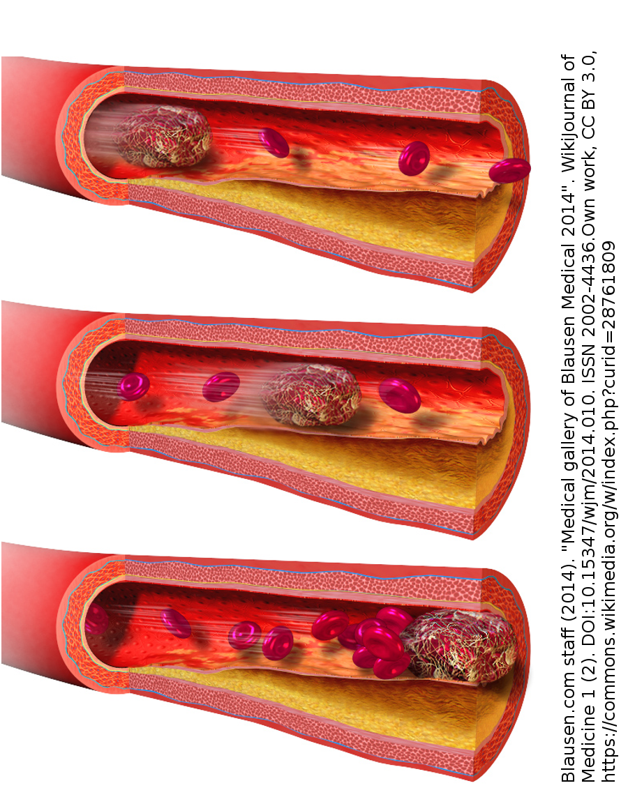 Abbildung 5: Blutgerinnsels, das zu einer Embolie führt
